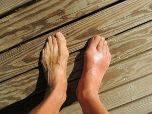 home remedies gout